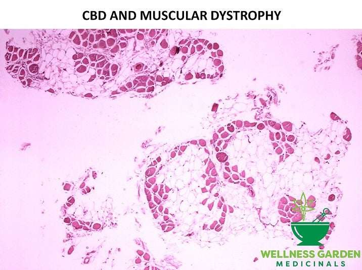 CBD and Muscular Dystrophy